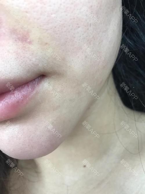 女星晒半脸瘀青照，眼袋淤青如何消(做眼袋脸上淤青多久能消除)