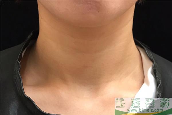 颈纹对女人的影响 颈纹一般多大年龄会出现