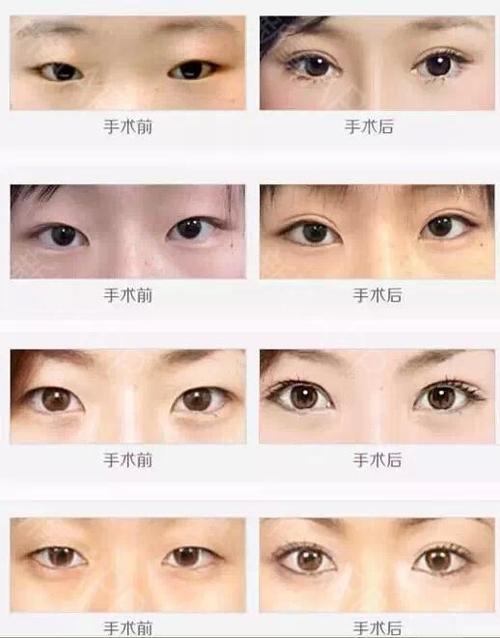 开眼角的明星,眼角内眦赘皮的女明(开了内眼角的女明星) 开眼角的明星,眼角内眦赘皮的女明(开了内眼角的女明星)