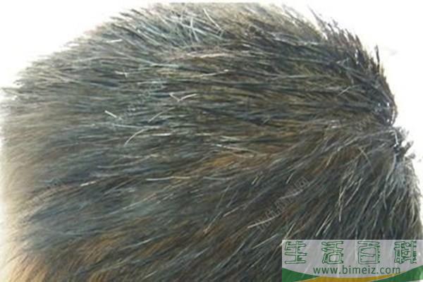 少年白吃什么可以调理?有白头发拔了有害吗(吃什么治疗少年白头发)