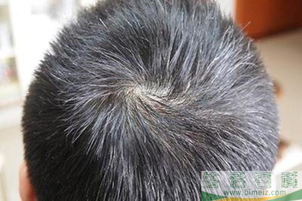 少年白吃什么可以调理?有白头发拔了有害吗(吃什么治疗少年白头发)