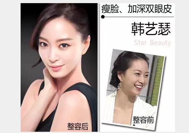 韩艺瑟整容前后对比图变化惊人