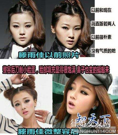 滕雨佳整容前后对比图(滕雨佳素颜) 滕雨佳整容前后对比图(滕雨佳素颜)