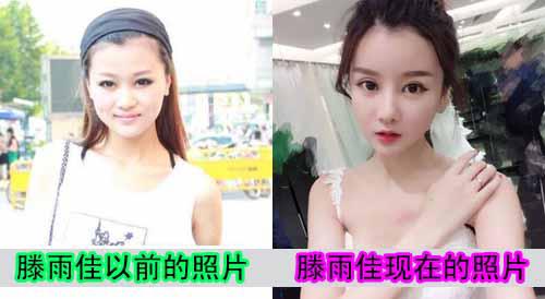 滕雨佳整容前后对比照片(滕雨佳素颜) 滕雨佳整容前后对比照片(滕雨佳素颜)