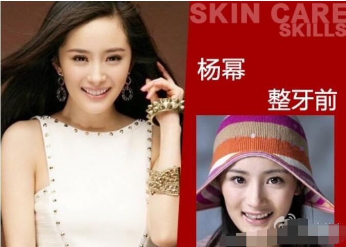 杨幂下牙只有6颗一笑没有后槽牙真假?是为 杨幂下牙只有6颗一笑没有后槽牙真假?是为