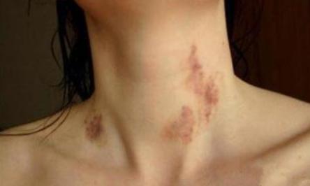 金韩彬脖子吻痕图(金泰妍吻痕)