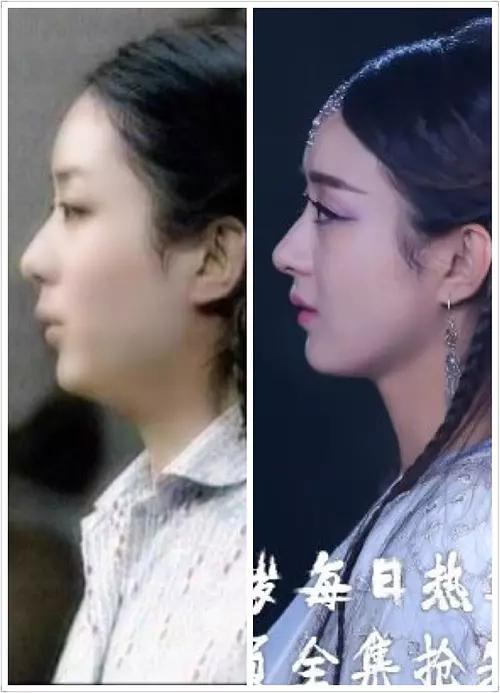 赵丽颖的鼻子整容过吗？丽颖的鼻子越来越高