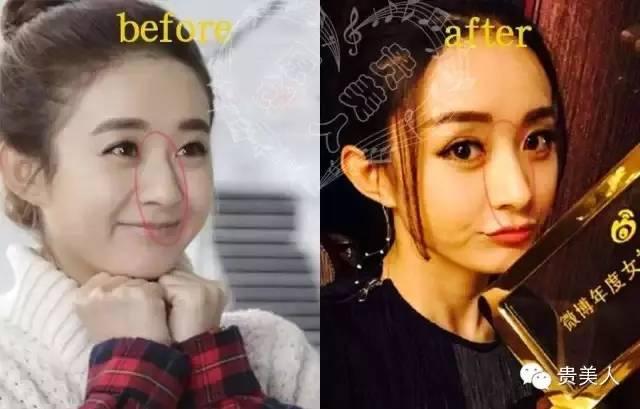 赵丽颖的鼻子整容过吗？丽颖的鼻子越来越高