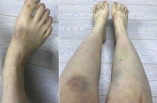 具荷拉家暴事件始末(附受伤图) 具荷拉家暴事件始末(附受伤图)