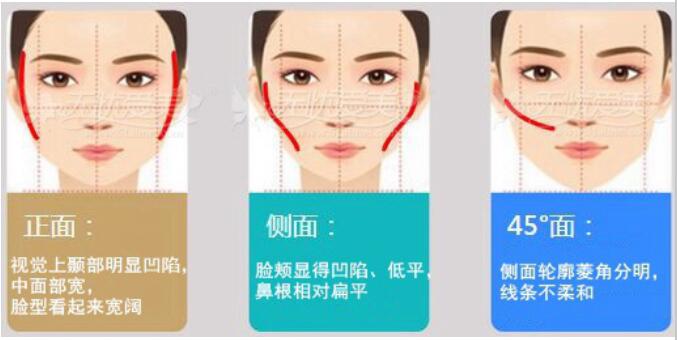 刘雯颧骨高会克夫纯属迷信(刘雯是高颧骨方脸吗) 刘雯颧骨高会克夫纯属迷信(刘雯是高颧骨方脸吗)