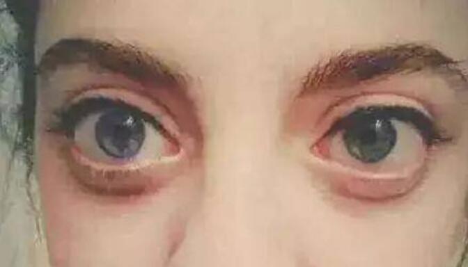 真实的金鱼眼是什么样子图片(金鱼眼女人图片)