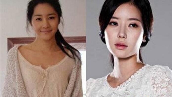 林秀香拉皮前后对比图