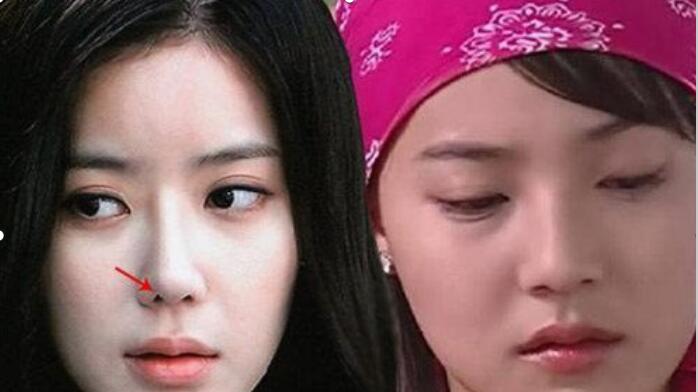 林秀香拉皮前后对比图