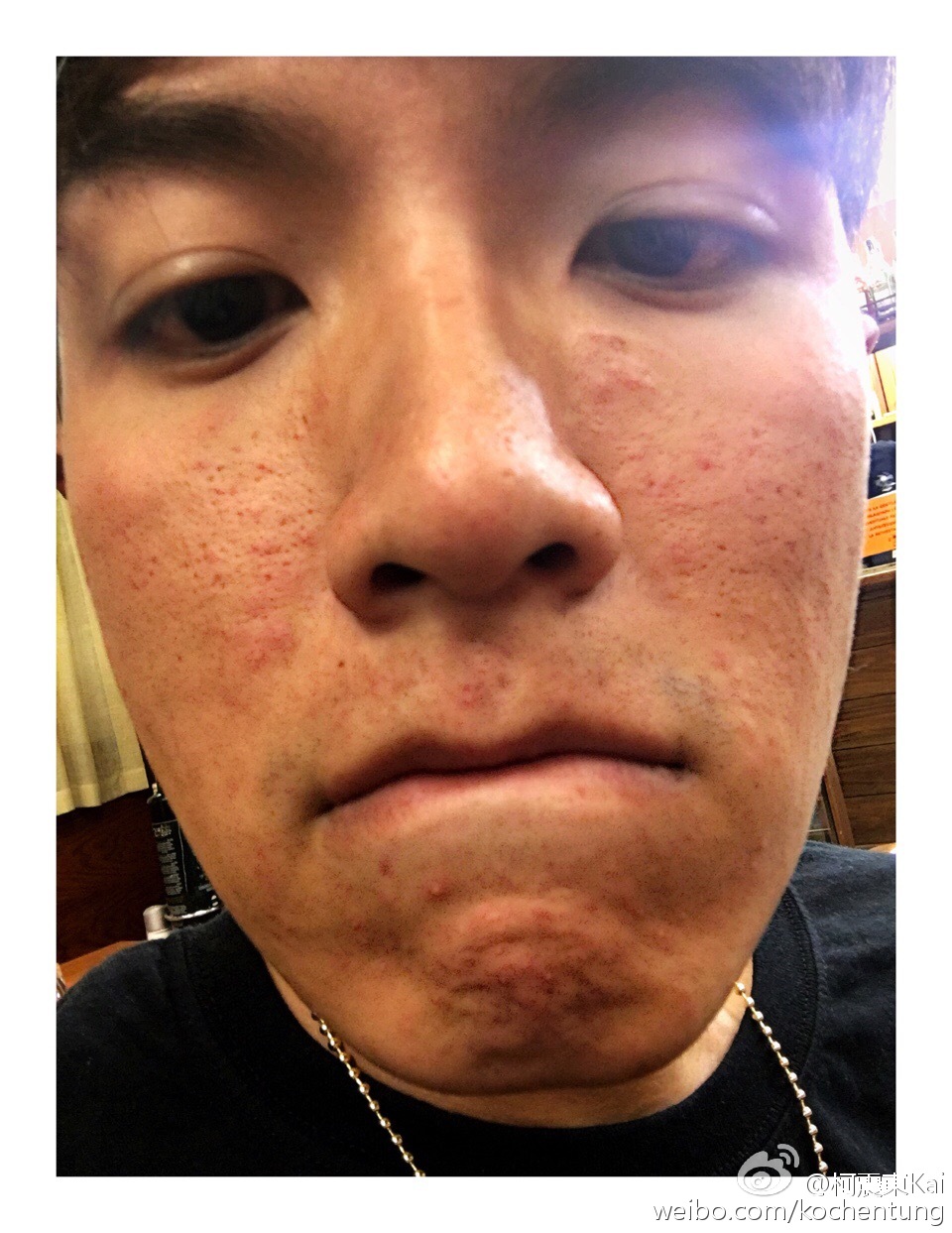 柯震东为什么叫凯凯、烂脸柯?柯震东将全面 柯震东为什么叫凯凯、烂脸柯?柯震东将全面