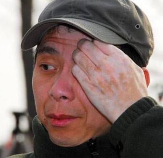 冯小刚白斑病自愈了真的吗？他白斑病最新的