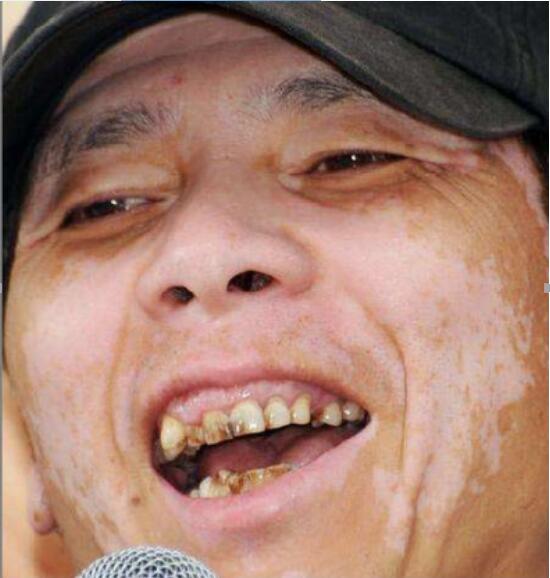 冯小刚白斑病自愈了真的吗？他白斑病最新的