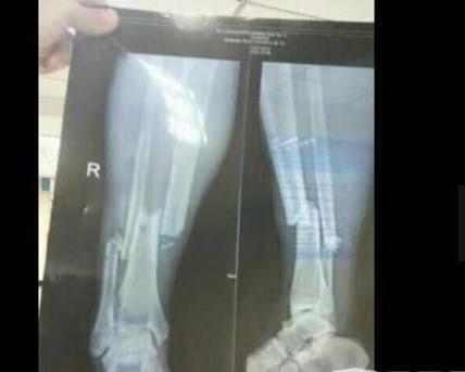 登巴巴断腿花了多少钱治疗 登巴巴断腿x光