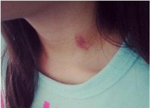 黄景瑜脖子上的吻痕是怎么回事