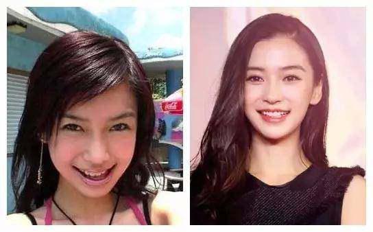 胡杏儿整牙前后对比照片(胡杏儿牙套)