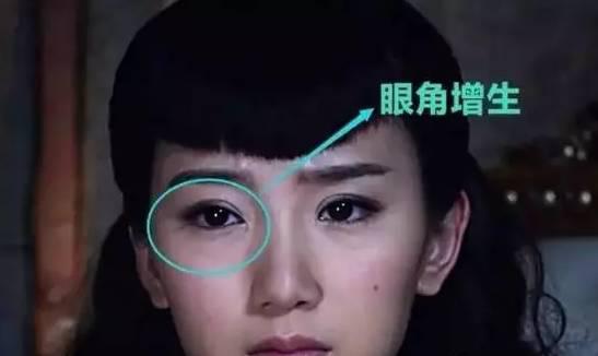 毛晓彤眼角的疤好明显照片(毛晓彤开眼角留疤图片) 毛晓彤眼角的疤好明显照片(毛晓彤开眼角留疤图片)