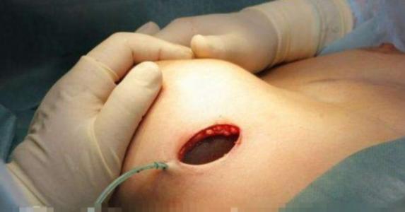 姜汉娜乳房下有刀口说明隆过胸