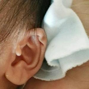 卜凡耳朵旁边的包是个什么？民间说耳朵上有