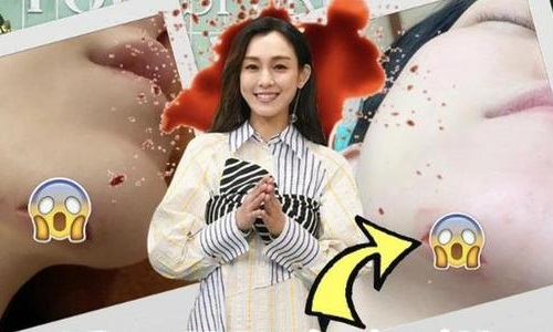 范玮琪下巴缝15针发文遭网友嘲讽