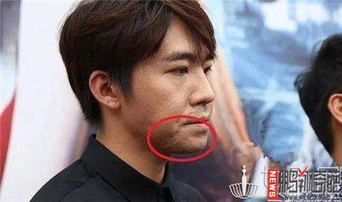 为什么俞灏明贴吧禁郑爽？俞灏明烧伤事件赔(俞灏明烧伤事件真相)