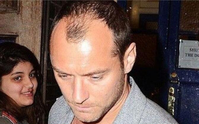 裘德洛为什么叫英伦玫瑰？裘德洛秃顶后植发